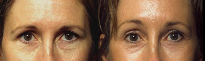 Brow Lift